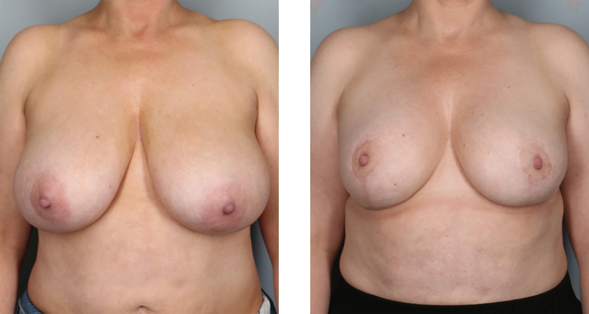 Breast Reduction before & after Patient 10
